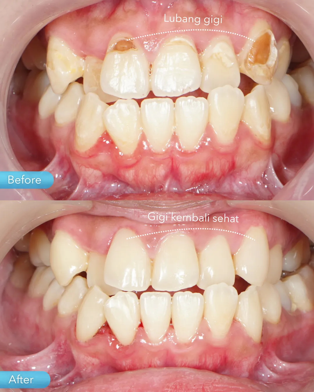 Dental filling result